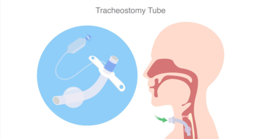 Tracheostomy care at home