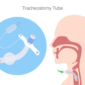 Tracheostomy Care at Home 85x85