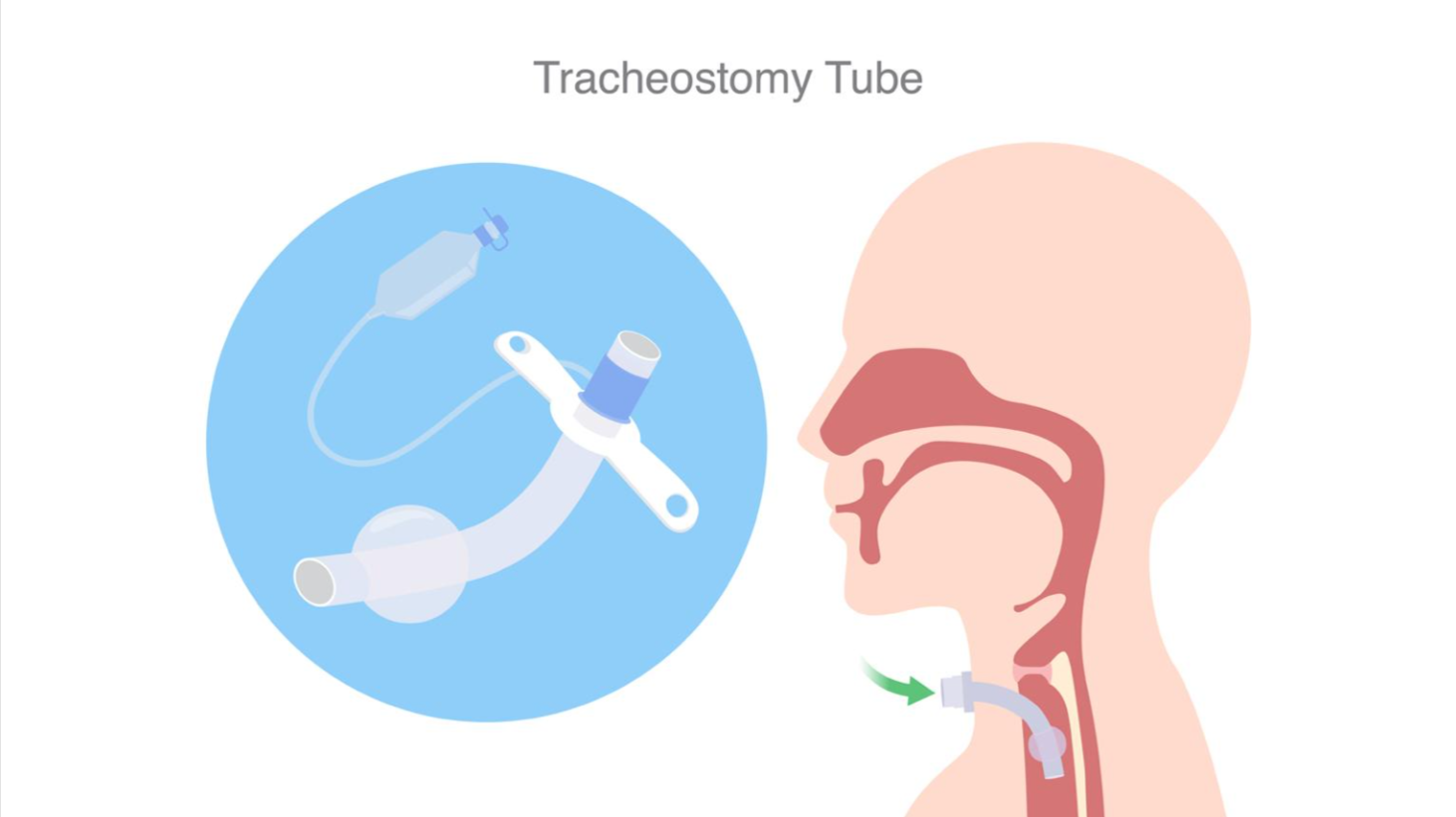 Tracheostomy care at home